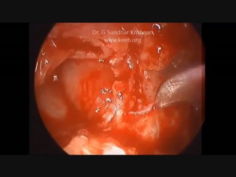 Endoscopic Tympanomastiodectomy