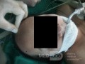 Endoscopic Third Ventriculostomy in a Benign Case of Aicardi Syndrome with Obstructive Hydrocephalus and Chiari Malformation type 1