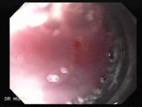 Severe Bleeding of the Upper Digestive System After Two Days of Band Ligation - Variceal Ligation, Part 1