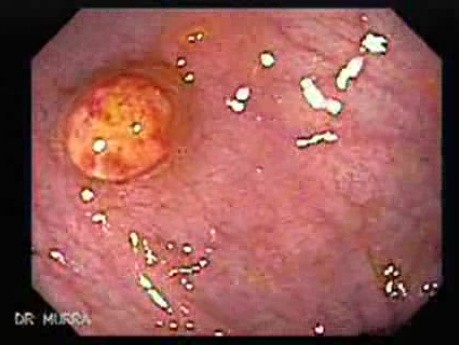 Non Familial Juvenile Polyposis Of The Colon (14 of 37)