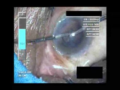 Cataract Surgery VII - Part 4