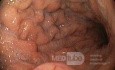 Unusual Appearance of Fundic Polyps. Chromoendoscopy. NET (1/6)