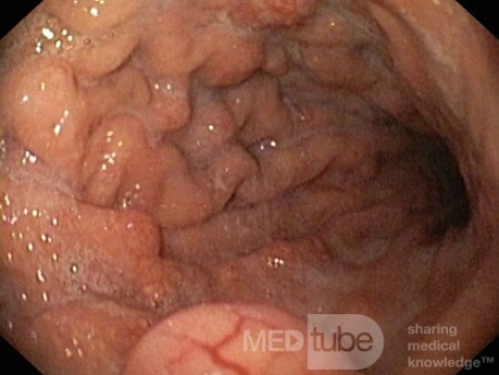 Unusual Appearance of Fundic Polyps. Chromoendoscopy. NET (1/6)