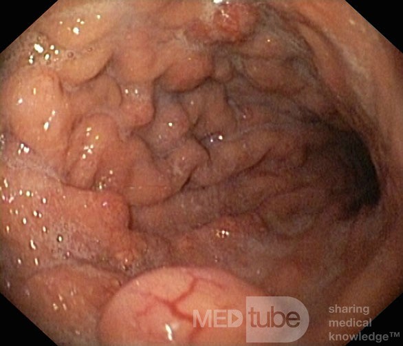 Unusual Appearance of Fundic Polyps. Chromoendoscopy. NET (1/6)