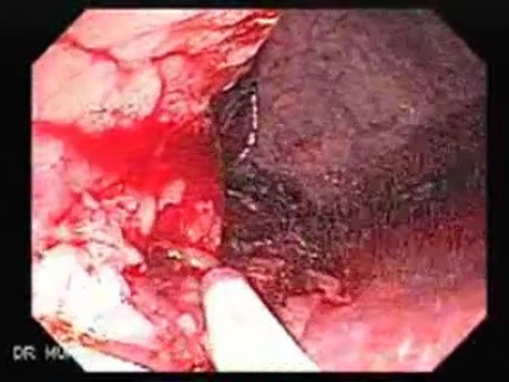 Endoscopic Resection of Giant Tubulo-Villous of the rectum (14 of 35)
