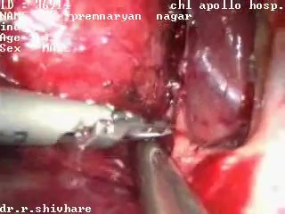 Laparoscopic right adrenalectomy - male patient