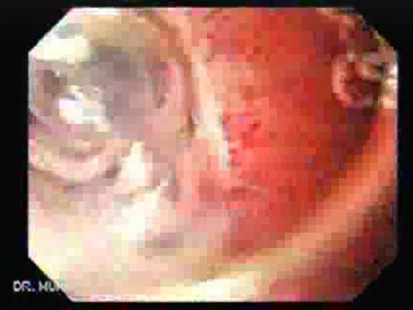 Gastrointestinal Stromal Tumor - GIST (1 of 65)