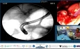 The Surgeon Left a Drain. We Left a Stent.