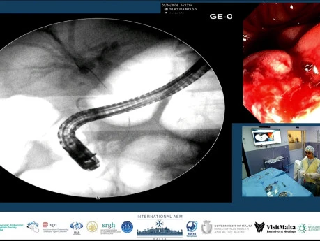 The Surgeon Left a Drain. We Left a Stent.