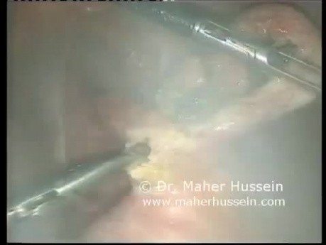 Appendectomy - Laparoscopic Approach