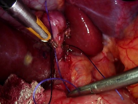 Laproscopic Cholecystectomy Avoiding CBD Complications