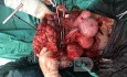Huge Myoma - Myomectomy