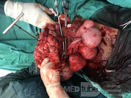 Huge Myoma - Myomectomy