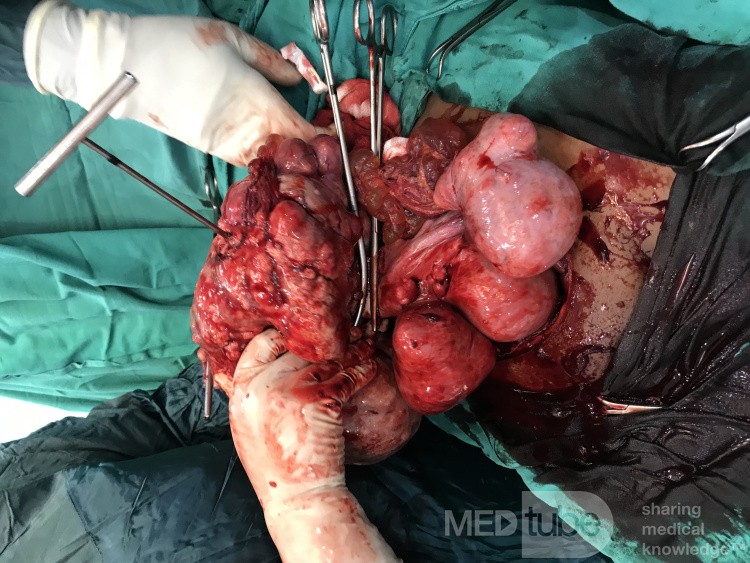 Huge Myoma - Myomectomy