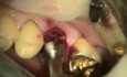 Immediate Molar Implant Featuring Southern Implants Max Dental Implant