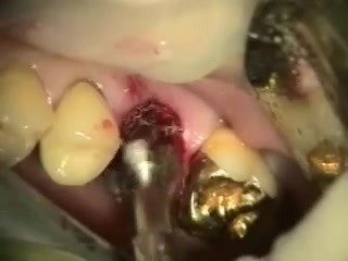 Immediate Molar Implant Featuring Southern Implants Max Dental Implant