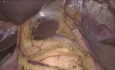 Heller Myotomy with Toupet Fundoplication