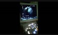 PD Stone Shadow Cut the Portal Vein View in EUS