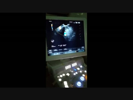 PD Stone Shadow Cut the Portal Vein View in EUS