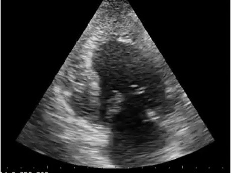 Echocardiography Quiz. Apical View. Is the Left Ventricle Normal