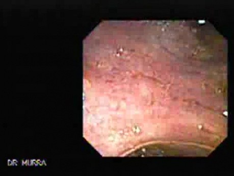 Choledocoduodenostomy and The Sump Syndrome (10 of 10)