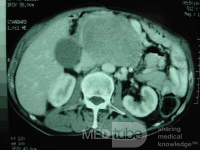 Gastric Ulcer with Gastrocolic fistula due to a Zollinger-
 Ellison Syndrome (23 of 33)