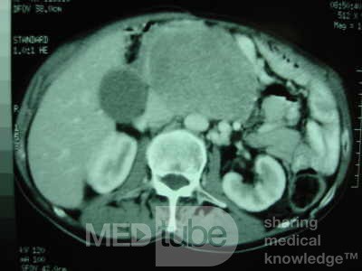 Gastric Ulcer with Gastrocolic fistula due to a Zollinger-
 Ellison Syndrome (23 of 33)