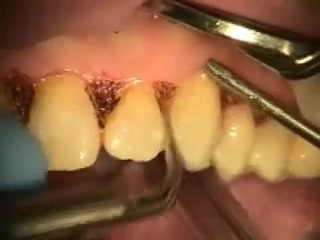 Dilantin Hyperplasia Laser Gingivectomy