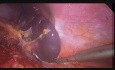 Laparoscopic Splenectomy for a Giant Splenic Cyst