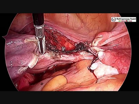 Safest Way to Perform Total Laparoscopic Hysterectomy with Bilateral Salpingo-oophorectomy