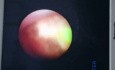 Ureteroscopy and Laser Lithotripsy