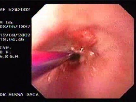 Zollinger- Ellison Syndrome - Gastric Ulcer with Gastrocolic Fistula (16 of 21)