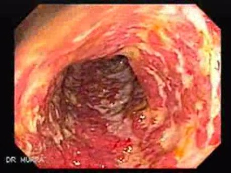 Multiple Rectal Ulcers (10 of 110)