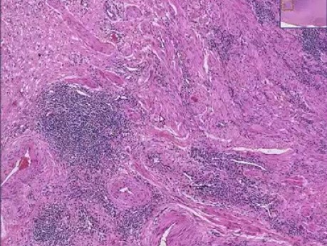 Chronic salpingitis