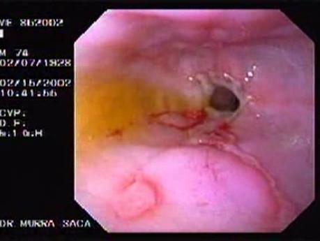 Esophageal Stricture Due To Gastroesophageal Reflux