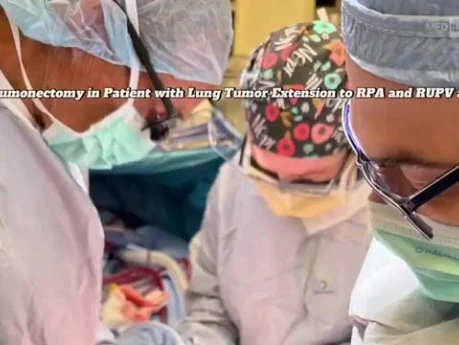 Right Lung Pneumonectomy and Arterial and Venous Stump Reconstruction in Patient with Invasive Lung Tumors