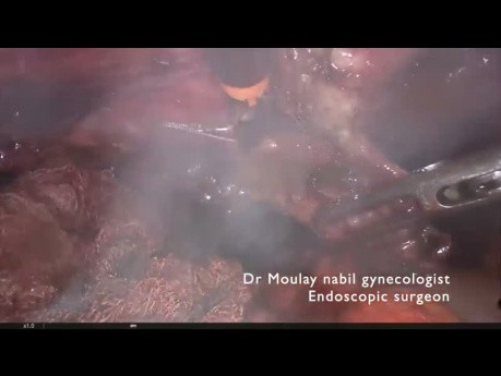 Deep Infiltrating Endometriosis, Ureterolysis, Uterosacral Resection