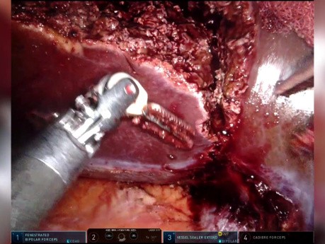 TachoSil for Sufficient Haemostasis After Robotic Assisted Partial Hepatectomy Segment 7