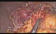 Esophageal Bougie Perforation - Intraoperative Management