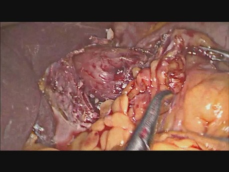 Esophageal Bougie Perforation - Intraoperative Management