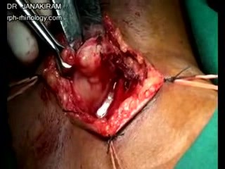 Submandibular Sialadenitis