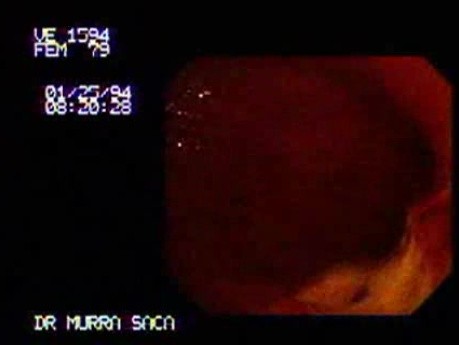 Large Ramified Ulcer of the Stomach (1 of 3)