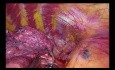 Subxiphoid Uniportal VATS apical anatomic segmentectomy (S1) for GGO
