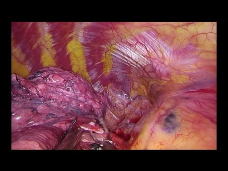 Subxiphoid Uniportal VATS apical anatomic segmentectomy (S1) for GGO