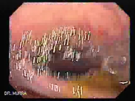 Colonoscopic Polypectomy (3 of 18)
