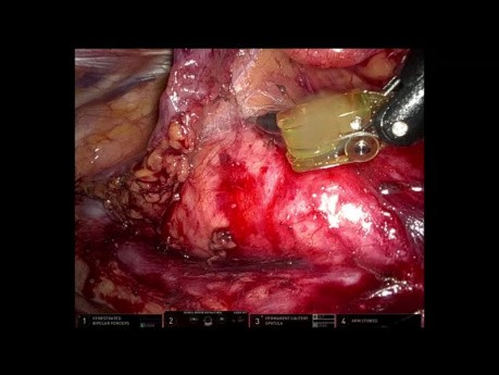 Robotic Right Sided Thymectomy with the Xi With Set up