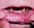 Hyperkeratosis Of The Lip [Leukoplakia]
