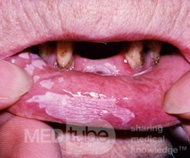 Hyperkeratosis Of The Lip [Leukoplakia]