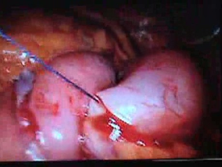 Jejunal Gastrointestinal Stromal tumor (GIST) (76 of 86)