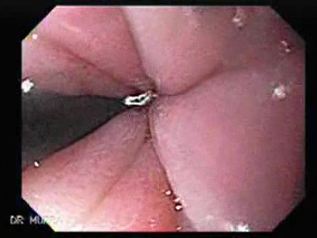 Endoscopic Baloon Dilation Of The Esophageal Stricture - Position Of The Inflated Baloon - 3/8